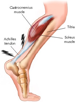 Achille's tendon