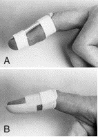 fingertip splints