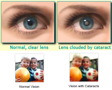 Cataract vs Normal
